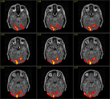 Иллюстрация возможностей функциональной ЯМР-томографии  мозга с сайта www.fmrib.ox.ac.uk